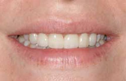 Gap closed between front teeth after cosmetic dentistry