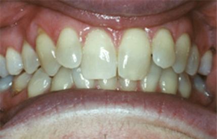Yellow and stained teeth before teeth whitening