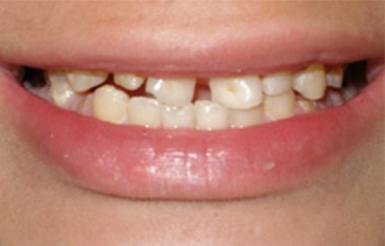 Decayed and damaged smile before restorative dentistry