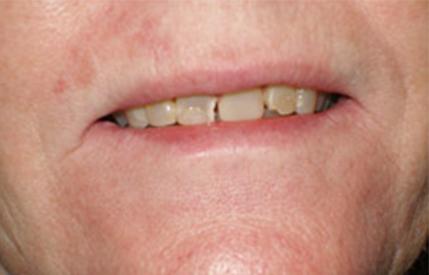 Yellow and damaged smile before cosmetic dentistry