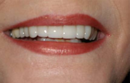 Perfect smile after teeth whitening and cosmetic dentistry