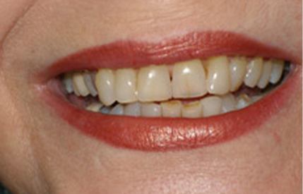 Severely yellowed teeth before teeth whitening and cosmetic dentistry