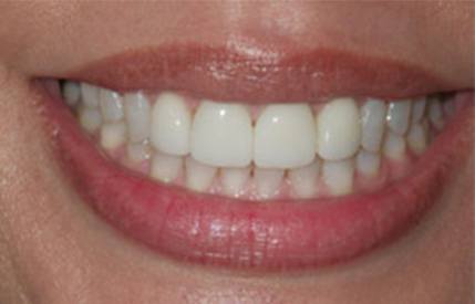 Gorgeous smile after Invisalign
