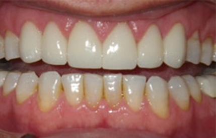 Healthy bright white smile after dental treatment