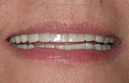 Worn discolored smile before cosmetic dentistry