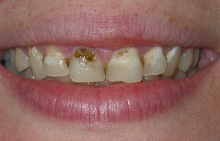 Decayed teeth before restorative dentistry treatment