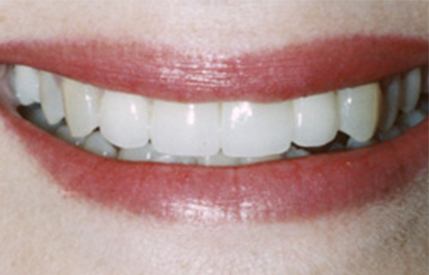 Gorgeous white smile after cosmetic dentistry