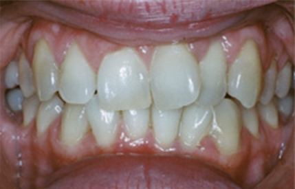 Discolored smile before cosmetic dentistry
