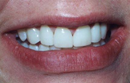 Beautiful smile after Invisalign clear braces and cosmetic dentistry