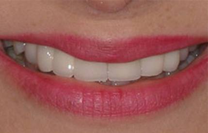 Healthy aligned smile after cosmetic dentistry