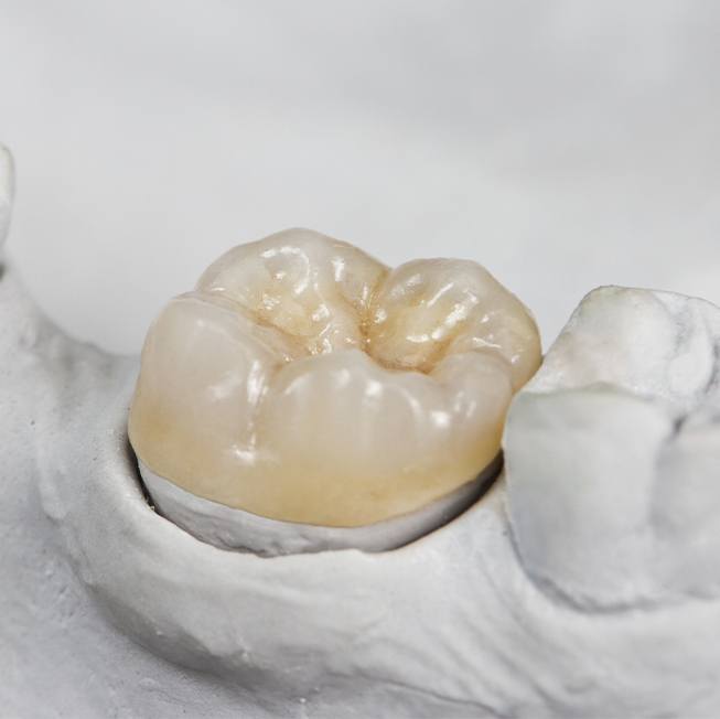 Metal free dental restoration on smile model