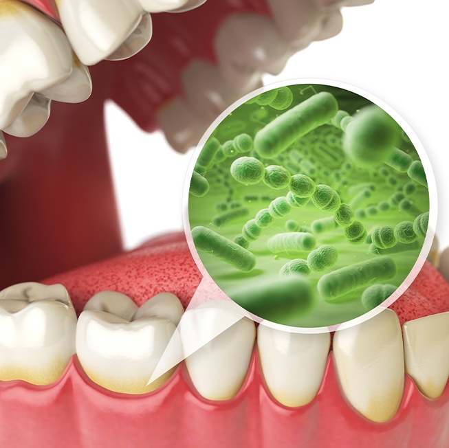 Animated smile with enlarged gum disease causing bacteria