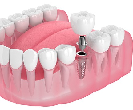 Illustration of a single dental implant