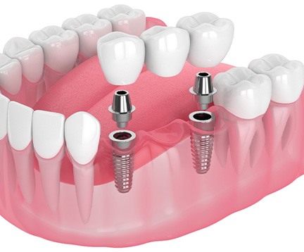 Illustration of an implant bridge