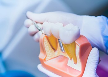 a person presenting a plastic model of a dental implant