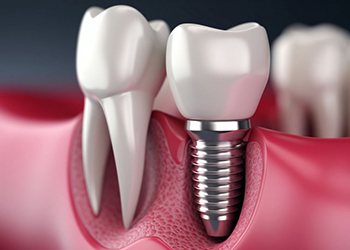 a 3 D illustration of a dental implant and abutment