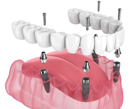 Illustration of an implant denture