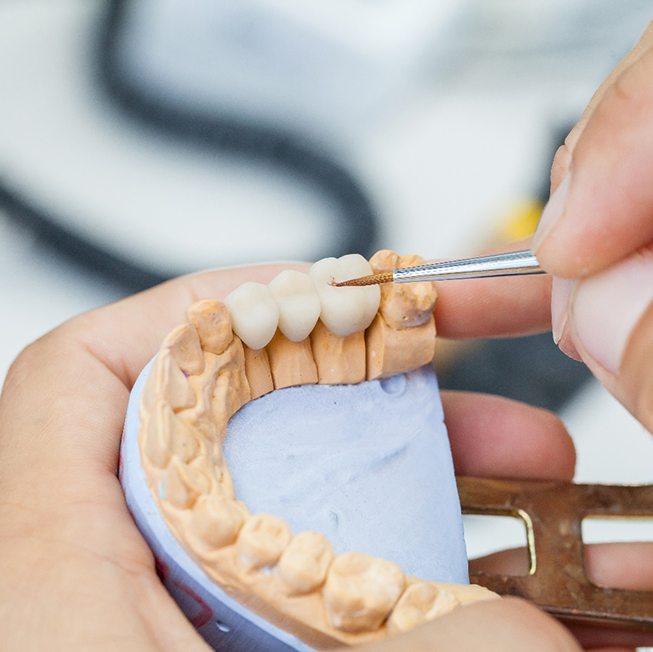 closeup of dental bridge in Corpus Christi