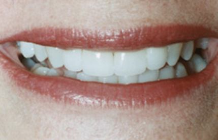 White smile after teeth whitening