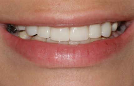 Gorgeous smile after dental restorations