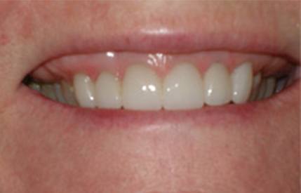 Healthy beautiful smile after cosmetic dentistry