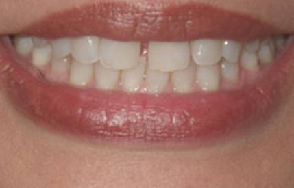 Unevenly spaced smile before Invisalign