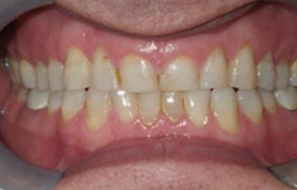 Discolored and decayed teeth