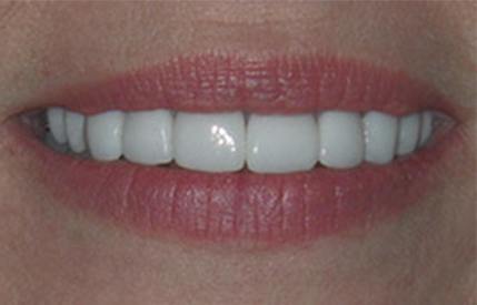 Bright white smile after teeth whitening