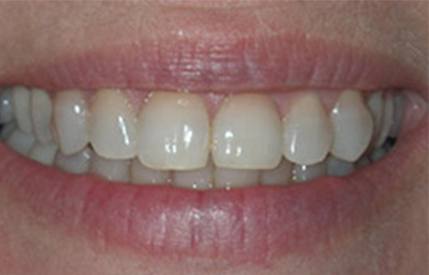 Smile before teeth whitening 