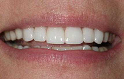 Healthy white smile after cosmetic dentistry