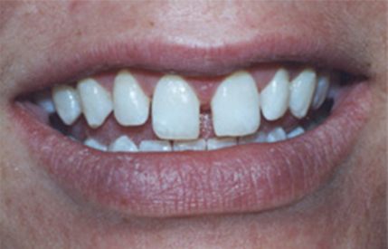 Gaps between teeth before orthodontic treatment