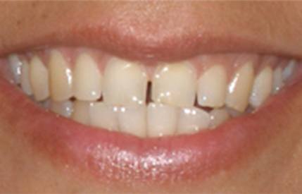 Discolored teeth with a gap between front teeth