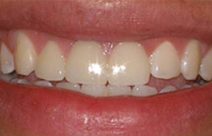 Healthy smile after restorative dentistry