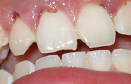 Cracked and damaged teeth