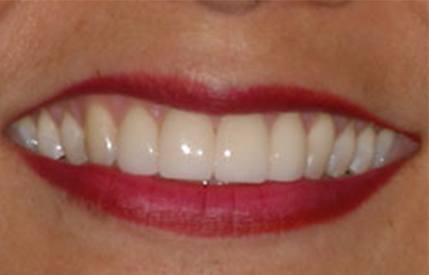 Brilliant white smile after teeth whitening