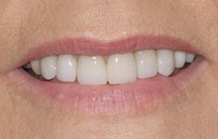 Bright smile after teeth whitening