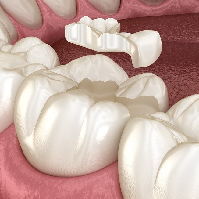 Animated tooth colored filling placement