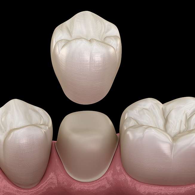 Animated dental crown placement