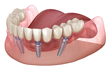 Implant dentures in Corpus Christi