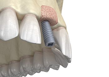 Bone graft for dental implants in Corpus Christi