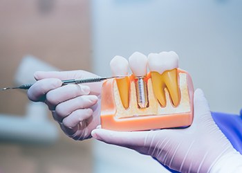 Dentist pointing to dental implant in Corpus Christi