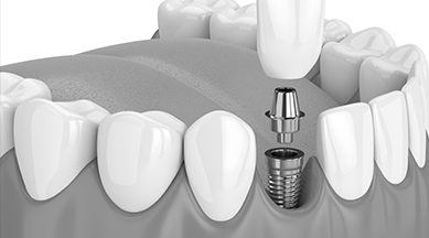 Animated dental implant supported dental crown placement