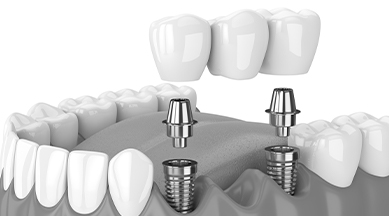 Animated dental implant supported fixed bridge placement