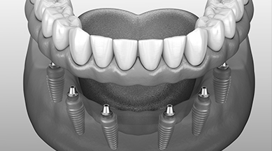 Animated dental implant supported denture