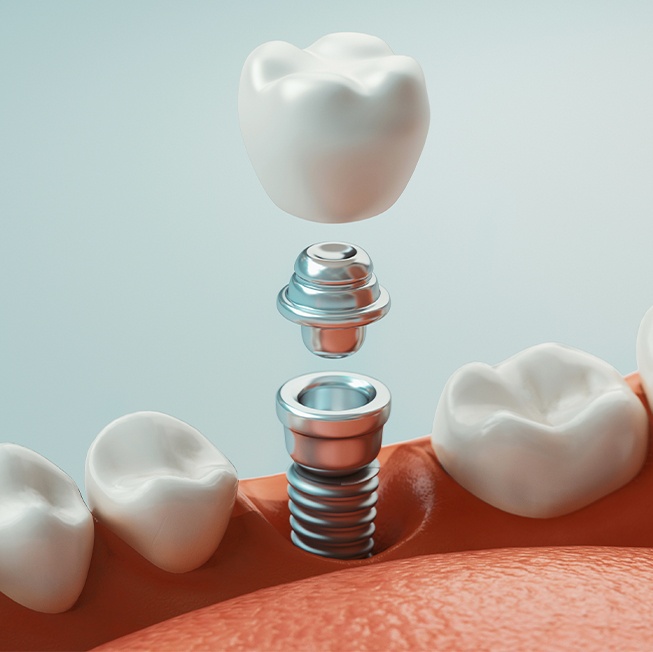 Animated parts of dental implant supported dental crown