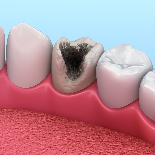 Animated smile with damaged tooth in need of metal free dental restoration in Corpus Christi