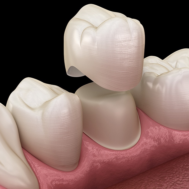 Animated dental crown placement