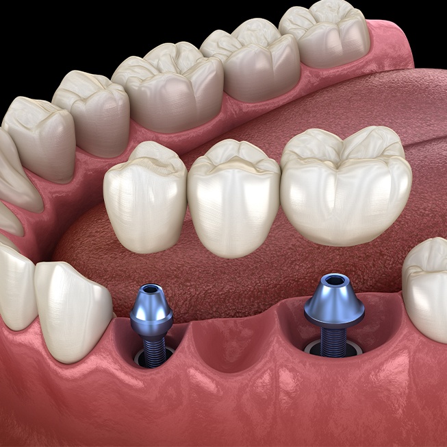 Animated dental bridge placement