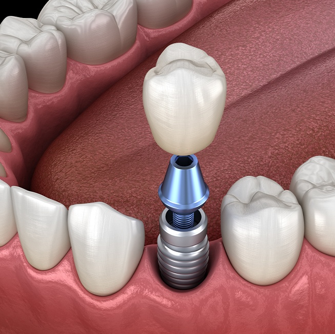 Animated dental implant supported dental crown