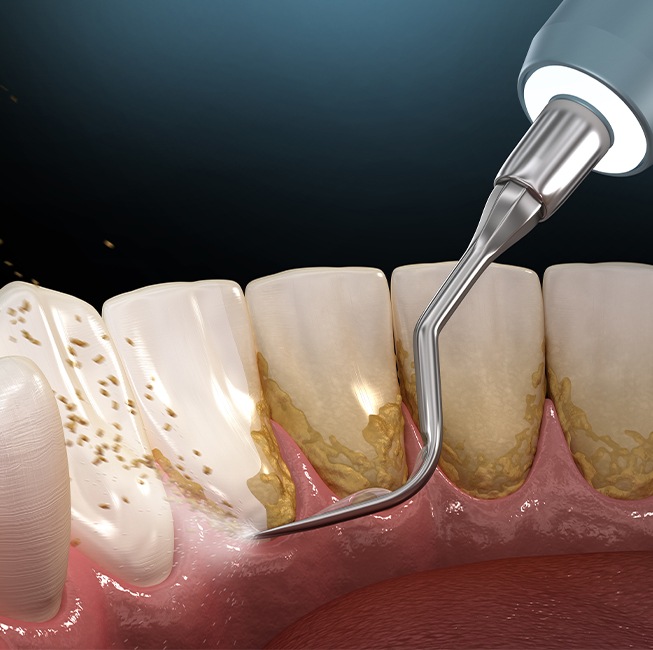 Animated rending of scaling and root planing periodontal treatment